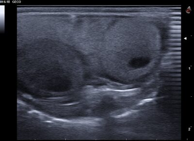 Caso clínico Geco: Folículos preovulatorios. Se aprecia el círculo anecogénico típico en su interior (ecografía del día de la primera visita).