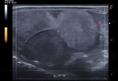 Caso clínico Geco: Presencia de folículos hiperecogénicos (asteriscos) y folículos preovulatorios normales, normoecogénicos y con el círculo anecogénico en su interior. Imagen de ecografía de la segunda visita.