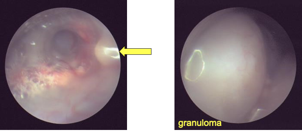 Caso clínico endoscopia aves: imagen de endoscopia