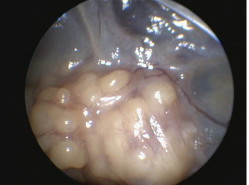 Caso clínico endoscopia aves: magen de toma de muestras: granuloma en cavidad celómica de una paloma doméstica