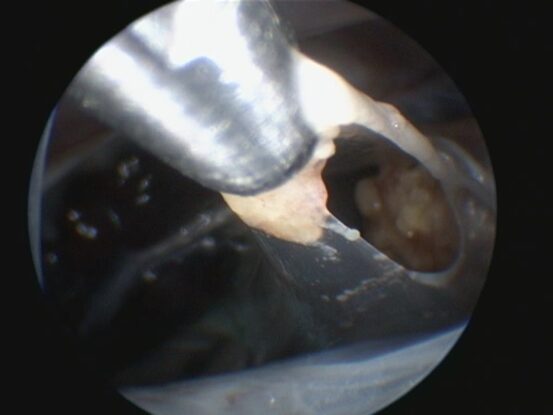 Caso clínico endoscopia aves: imagen Biopsia del granuloma en cavidad celómica